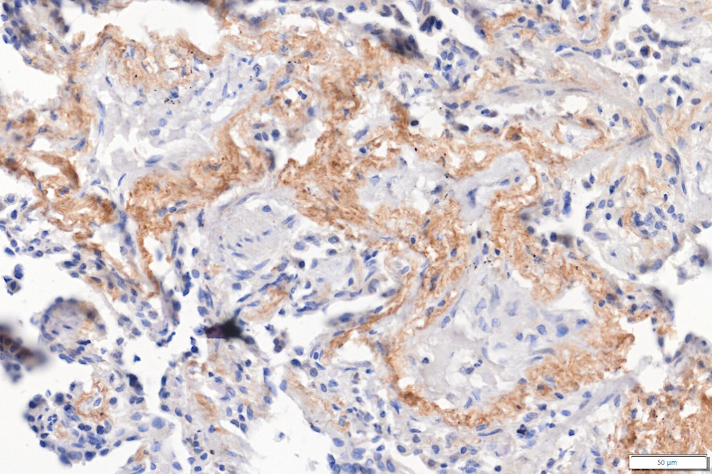 Fleming researchers have uncovered a novel role for fibroblast-expressed Versican, a multifunctional ECM proteoglycan, as an autologous fibrotic brake that suppresses pulmonary fibrosis.
